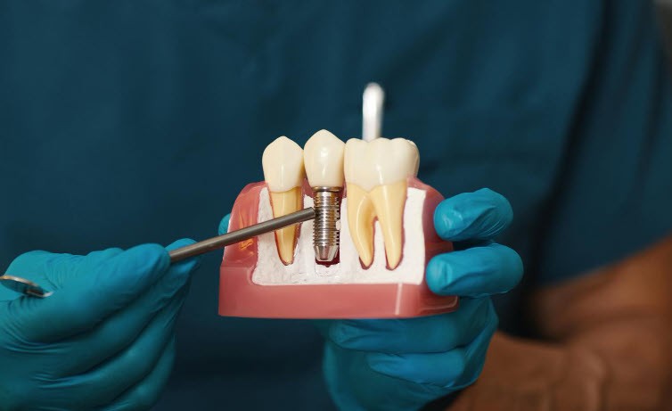 Dental implant in bottom teeth from Edmonds Dental Studio in Edmonds, WA