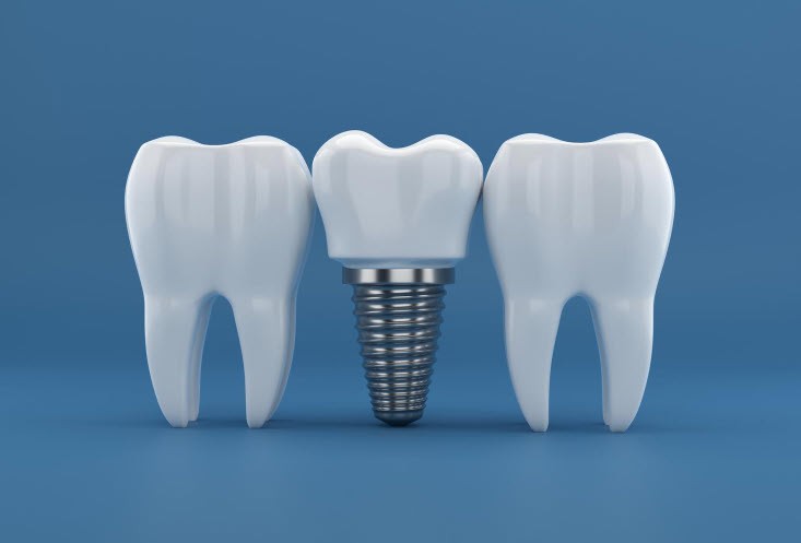 Illustration of a dental implant at Edmonds Dental Studio in Edmonds Washington.