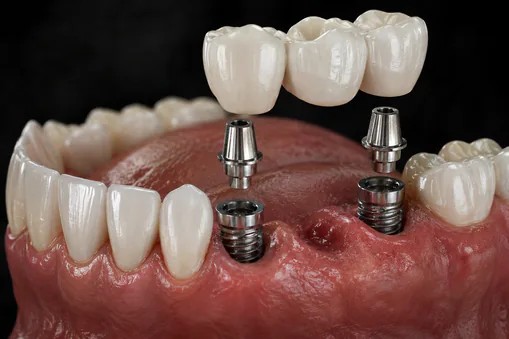 Replacing Multiple Teeth at Edmonds Dental Studio in Edmonds, WA
