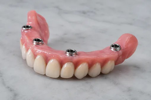 full dentures implants diagram at Edmonds Dental Studio in Edmonds Washington