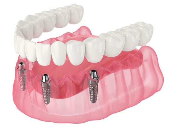 Diagram of All on X process at Edmonds Dental Studio in Edmonds Washington.