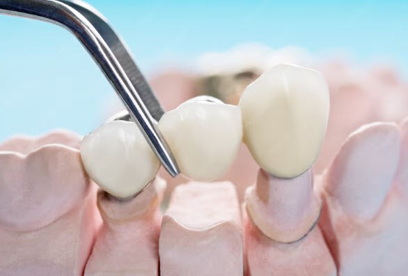 Rendering of jaw with dental bridge at Edmonds Dental Studio in Edmonds Washington