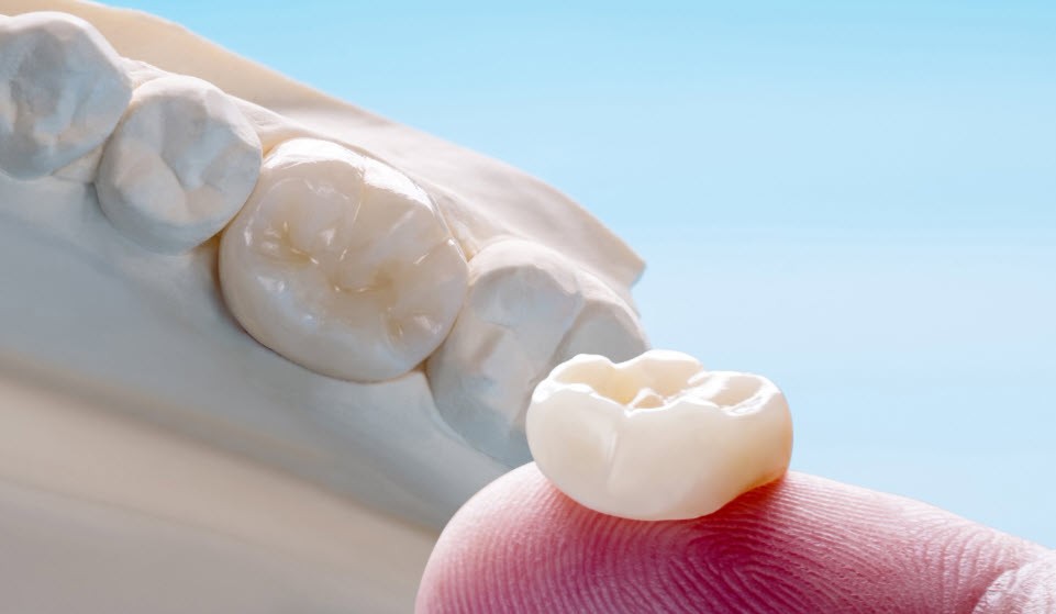 Rendering of jaw with dental crown at Edmonds Dental Studio in Edmonds Washington.