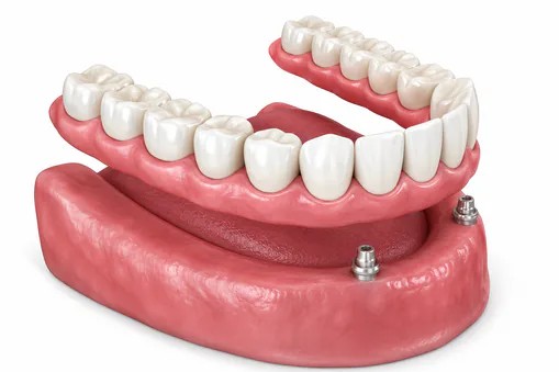 3D rendering of overdentures in a mouth at Edmonds Dental Studio in Edmonds Washington