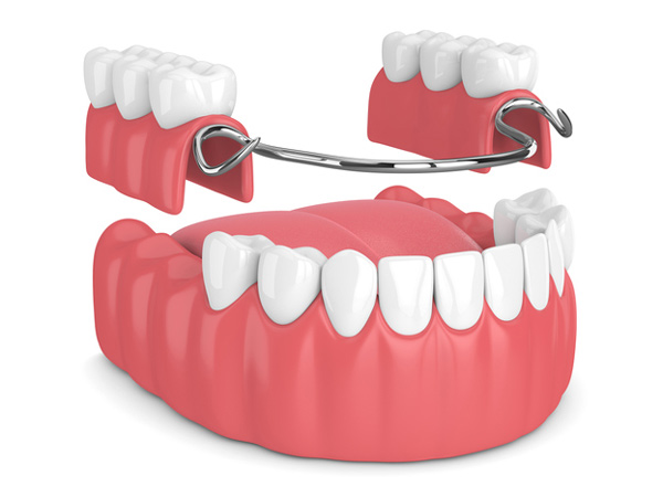 Rendering of removable partial denture at Edmonds Dental Studio in Edmonds WA