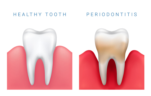 Diagram of healthy tooth compared to periodontitis diseased tooth at Edmonds Dental Studio in Edmonds Washington.