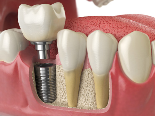 	Implant cross section diagram at Edmonds Dental Studio in Edmonds, WA